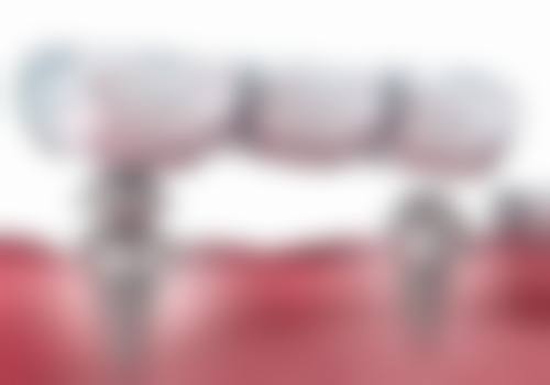 韩国奥齿泰与雅定种植体价格对比