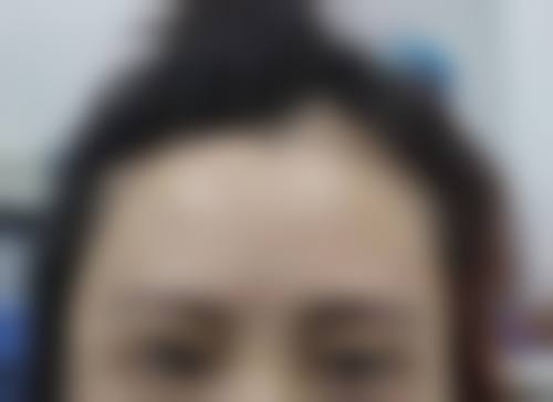 临床实例分享:娄底美科医疗美容门诊部许艳芳