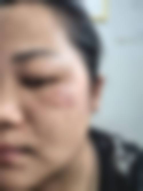 临床实例分享天津大港伊莱美医疗美容专科门诊部黄双全