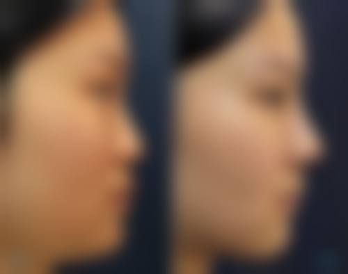 临床实例分享:天津缪慈医疗美容门诊部徐正一
