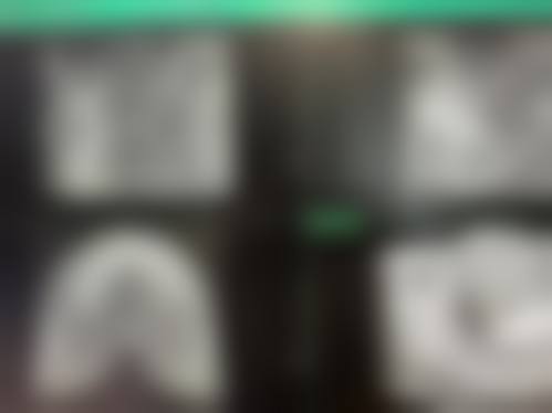 临床实例分享深圳新广仁口腔门诊部尹天资