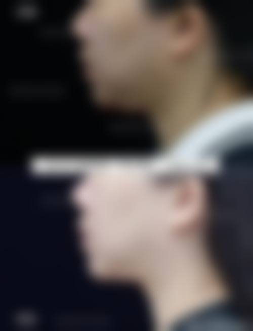 擅长项目详解:眼鼻整形与脂肪填充技术